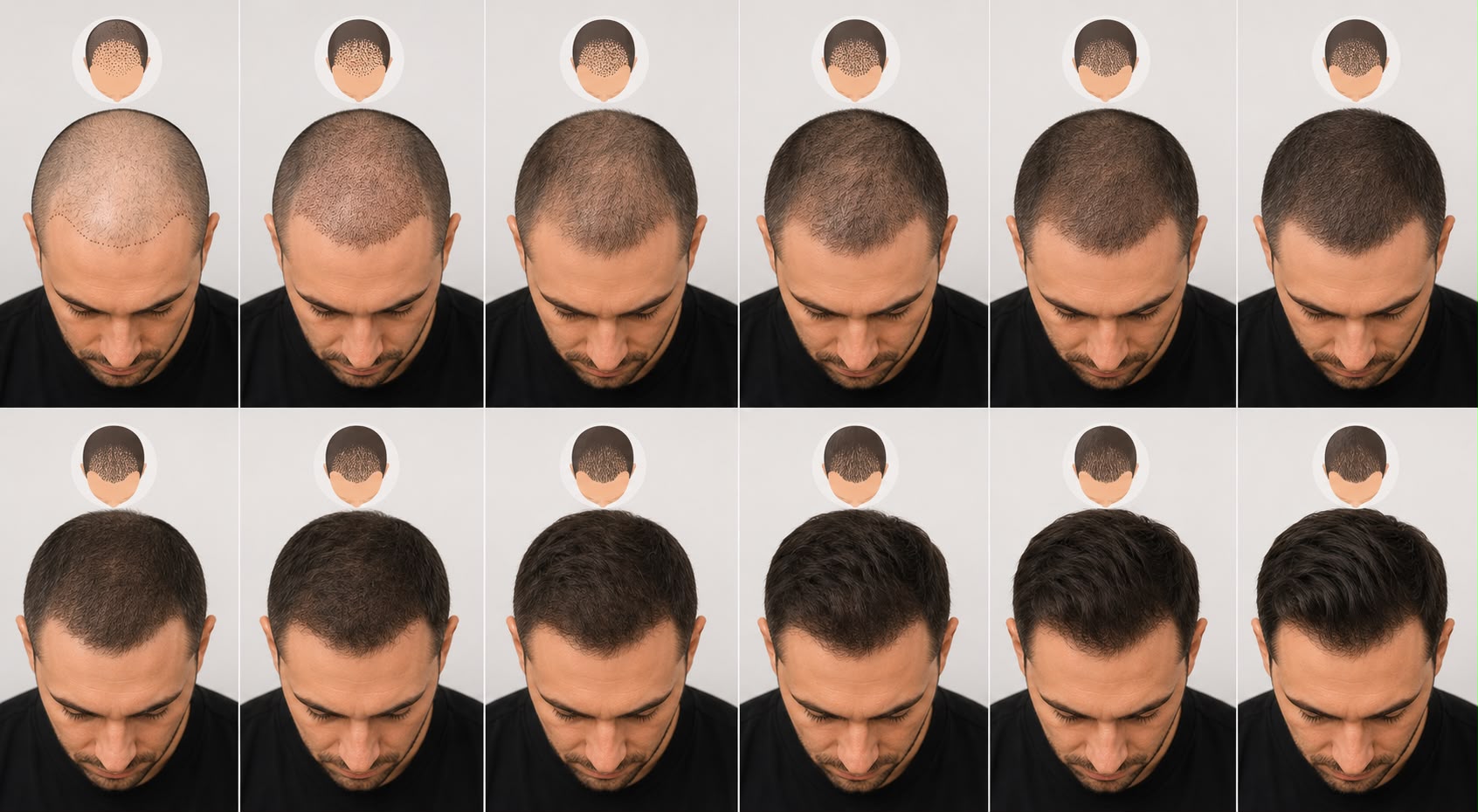 A month-by-month hair transplant growth timeline, from the shaved and scabbed first day through to full regrowth